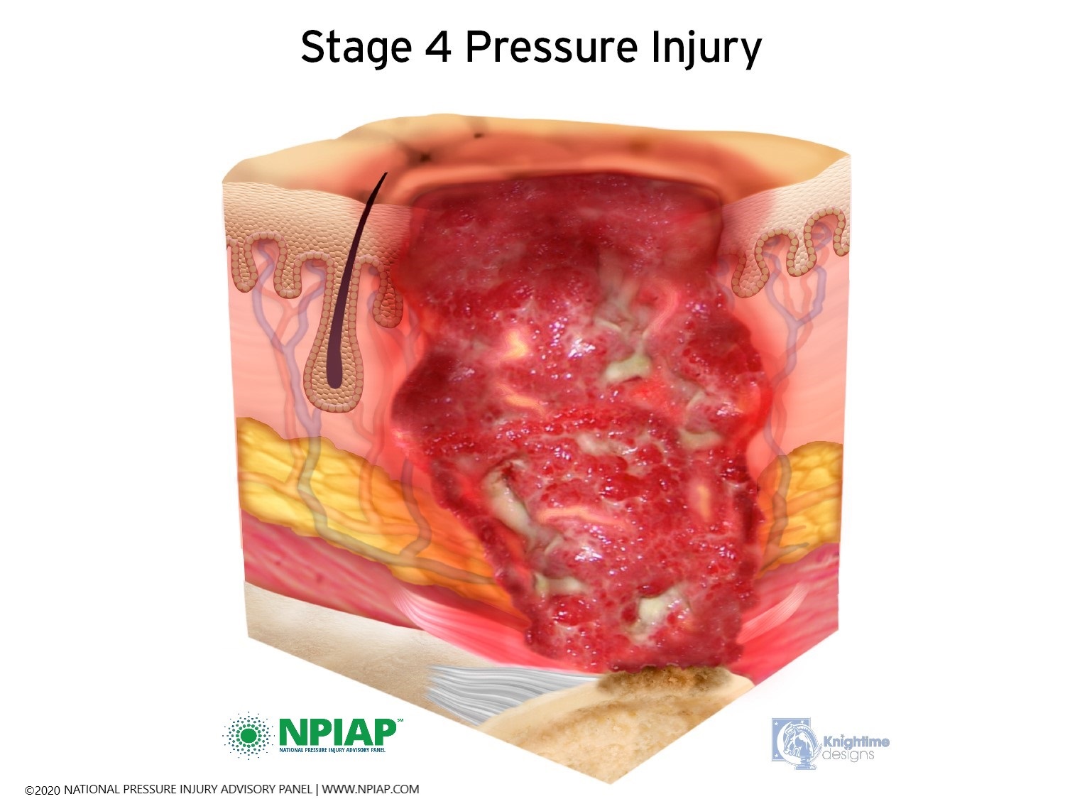 Pressure Injury Stages - National Pressure Ulcer Advisory Panel