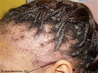 alopecia_traction_3_low.jpg
